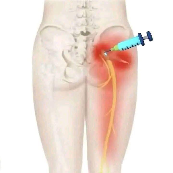 b12 injection hit nerve Buttock intramuscular risks and damage reconstitution supplies Peptide BPC-157 | Intra|V Bulk Discount:x 60