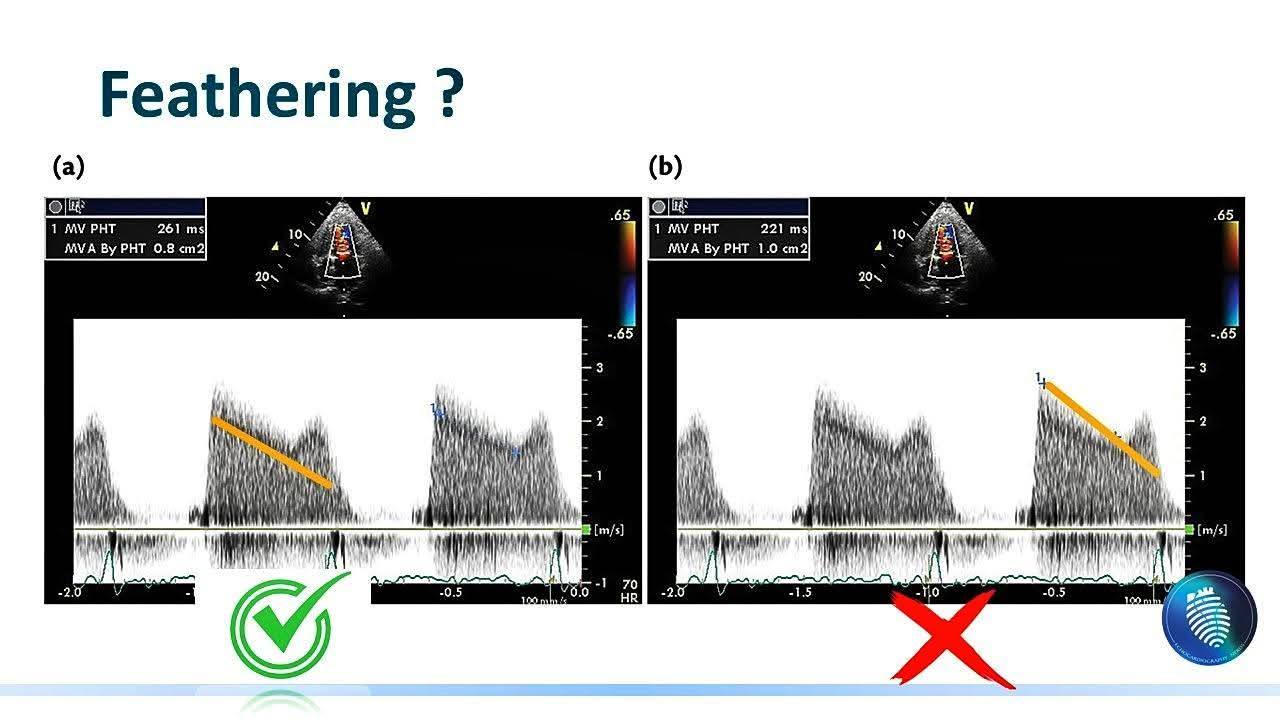 🚨Common error during MVA assessment by PHT slope .... | Facebook