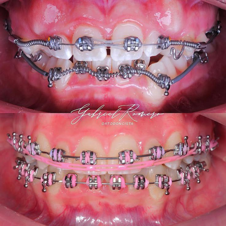 Ortho - 🔘 Orthodontic Springs: Precision Mechanics for Controlled Tooth ...