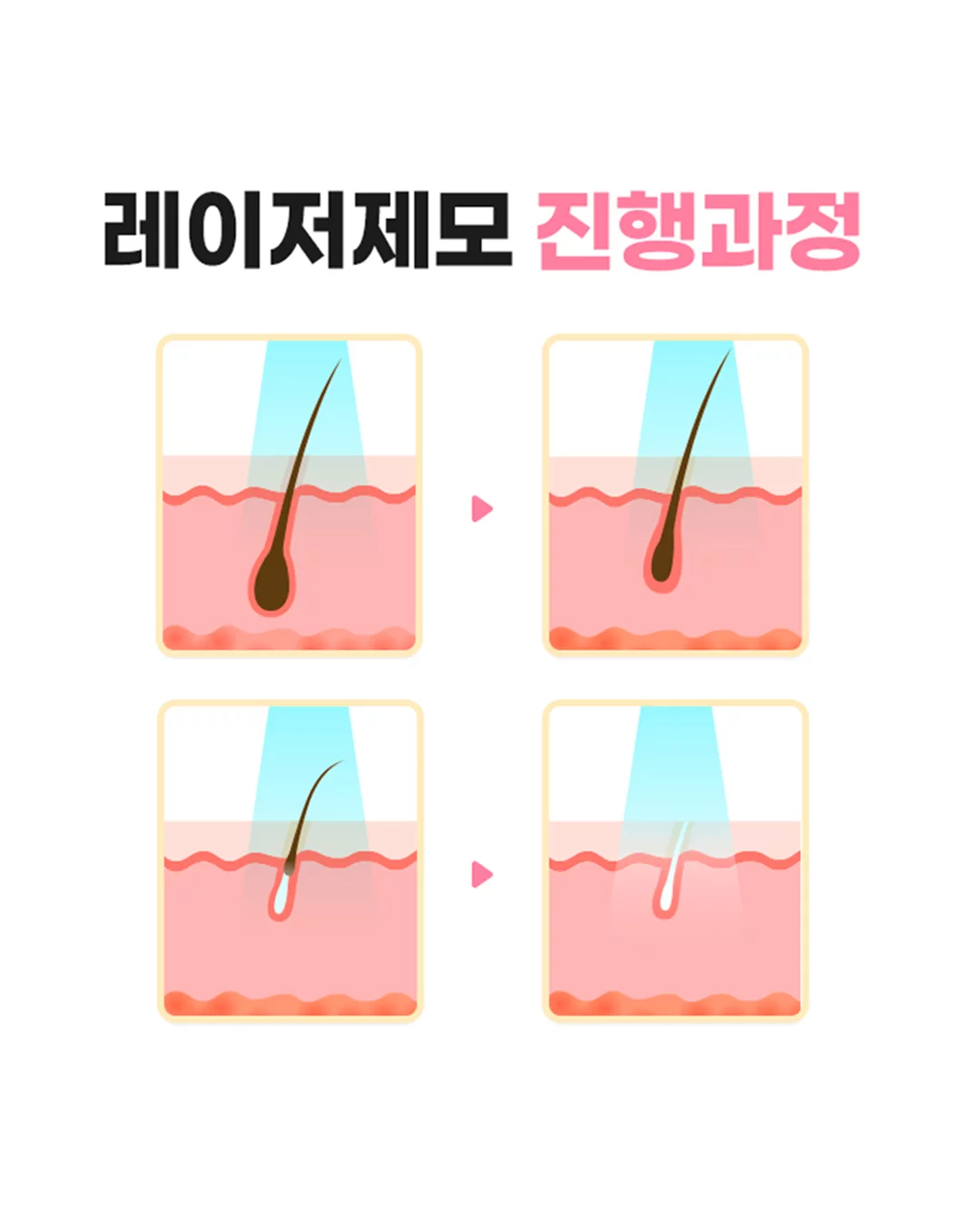 리버스클리닉 - [레이저 제모 진행과정, 한눈에 정리!] 1️⃣ 레이저 조사 멜라닌 색소를 인식해 모근에 에너지를 전달합니다 ...