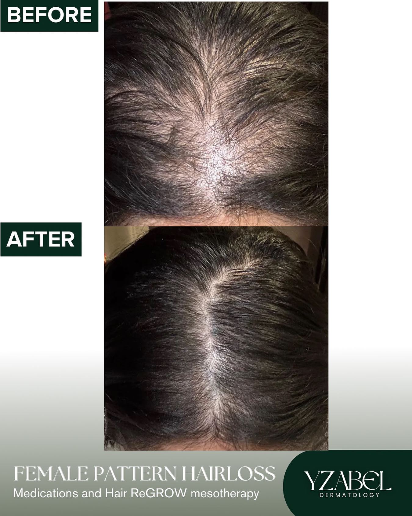 Dr. - 💫 “Doc akala ko tuluyan na akong makakalbo…” 🥲 Female pattern ...