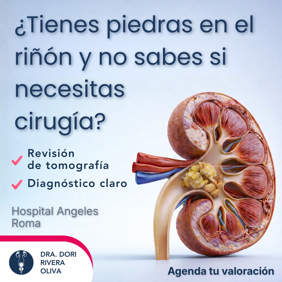 👩‍⚕️ ¿Sabes qué es la litiasis... - Uróloga Dra. Dori Rivera | Facebook