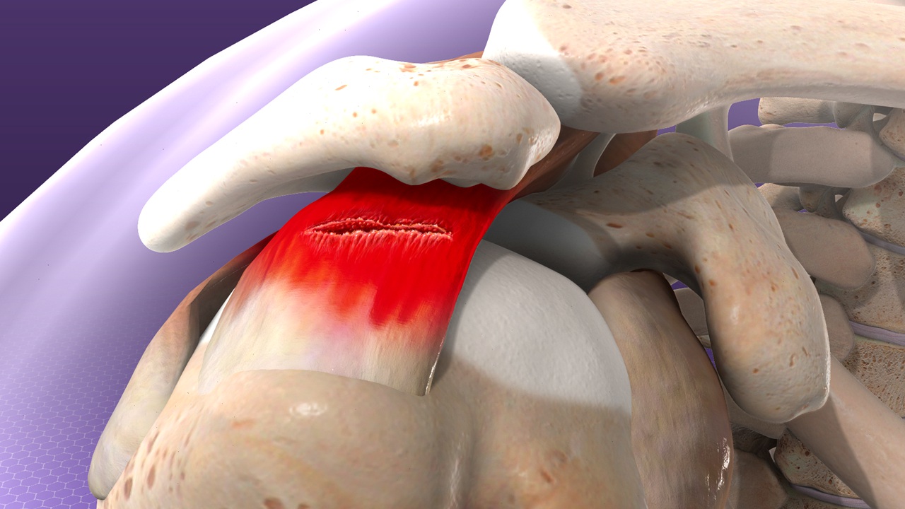 Understanding Rotator Cuff Injuries and Treatments Shoulder pain is one ...