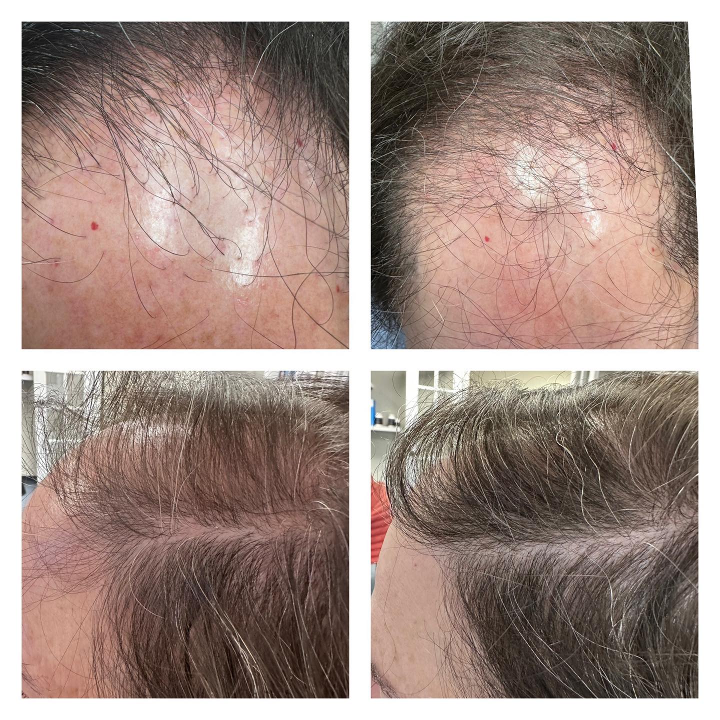 ghk-cu hair growth before and after GHK for Loss – Just 3 Months In! is a game-changer for hair restoration—just 3 months of treatment the difference speaks for itself. ✨ Stimulates ✨ Improves follicle bpc-157 oral vs injection bundle Program:Monthly