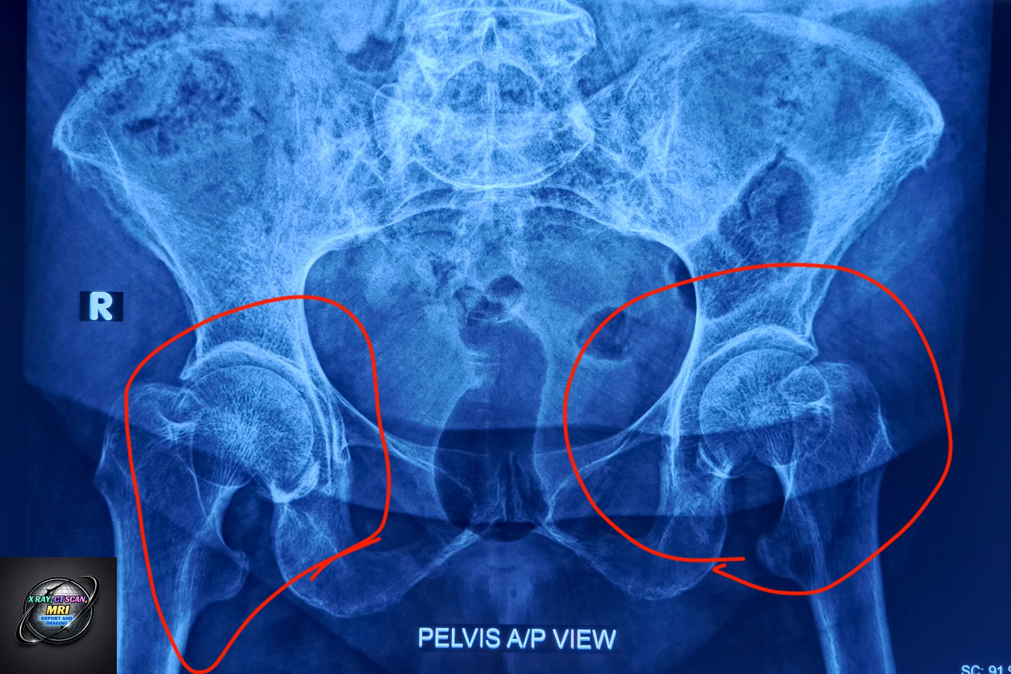 Human Anatomy Group | Pelvis AP View X-Ray | Complete Pelvic Bone & Hip ...