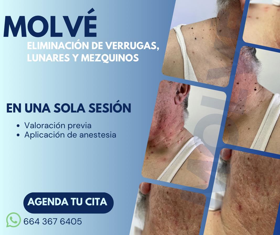 MOLVÉ - Enfermería General | Tijuana