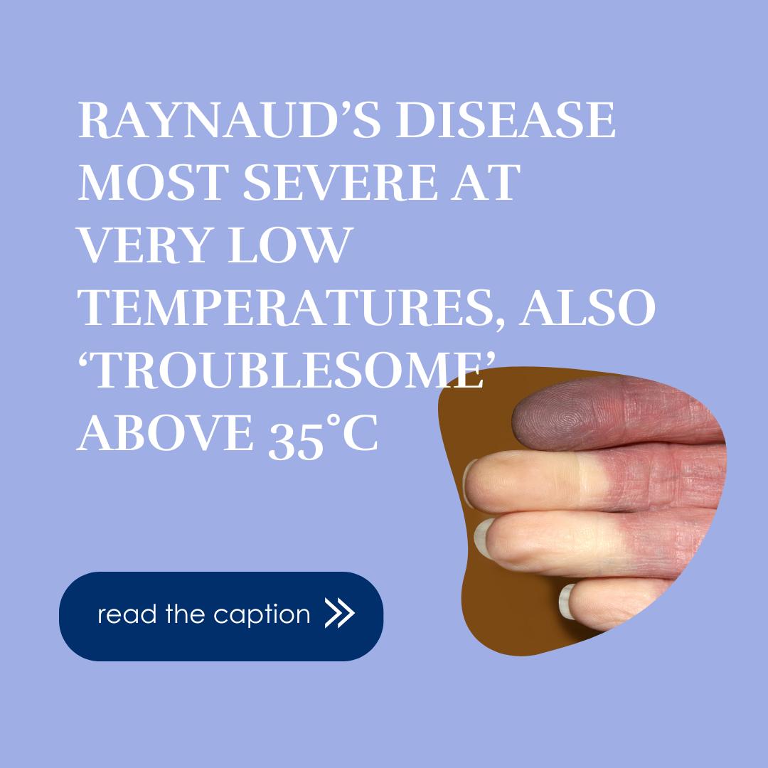 Columbia - 🌡️ Raynaud’s Isn’t Just a Cold Weather Condition! 🌡️ A new ...