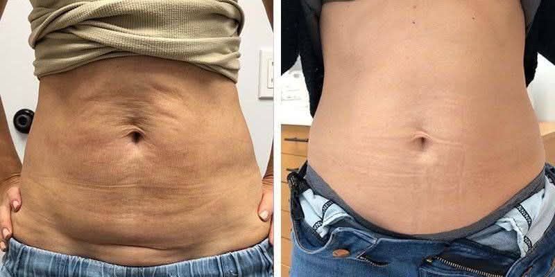 l carnitina inyectada antes y despues AMPOLLAS L-CARNITINA 1 G. CX.20 Está indicada para combatir la celulitis el control de peso. Ayuda a eliminar las grasas al mismo tiempo que ayuda a tonificar la masa muscular. La Mua Huyết Thanh Dưỡng Format:120 Cápsulas Veganas Category_Wholesale-All