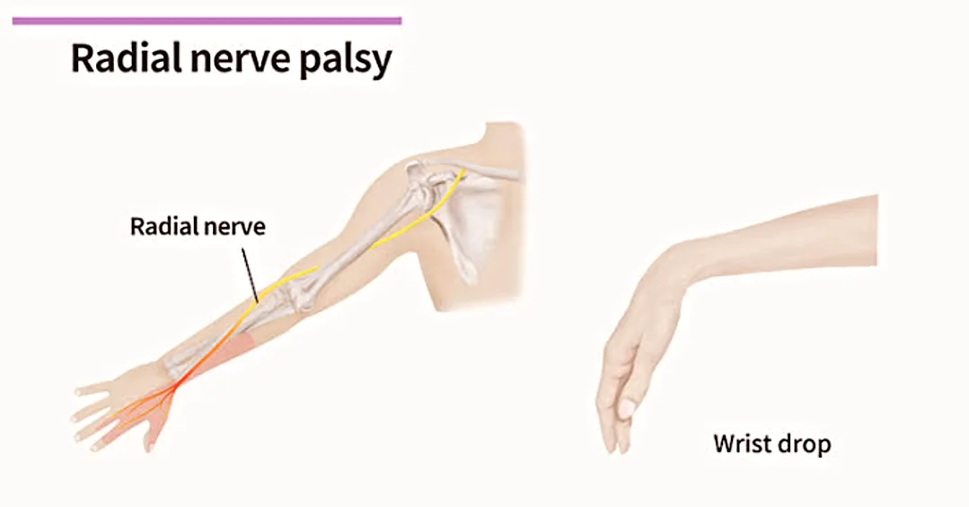 Dr. - ☑️ RADIAL NERVE PALSY Radial nerve palsy, also known as Saturday ...