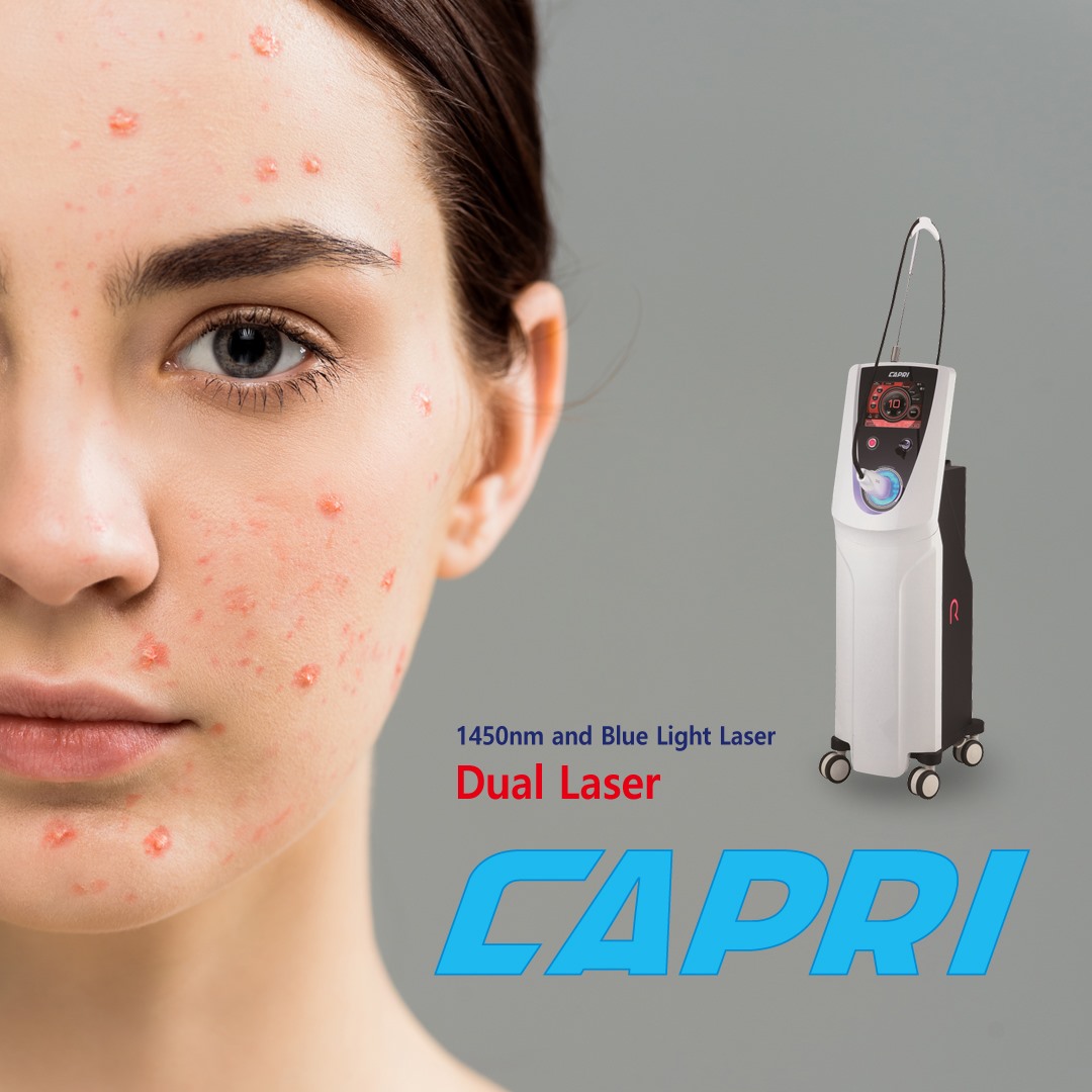 澳門藍雷射 Capri Laser