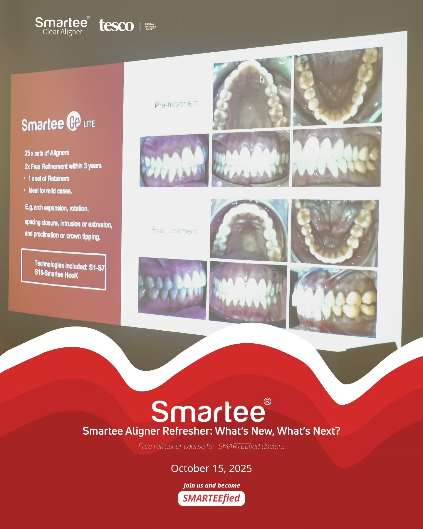 Smartee Clear Aligner Philippines | Makati