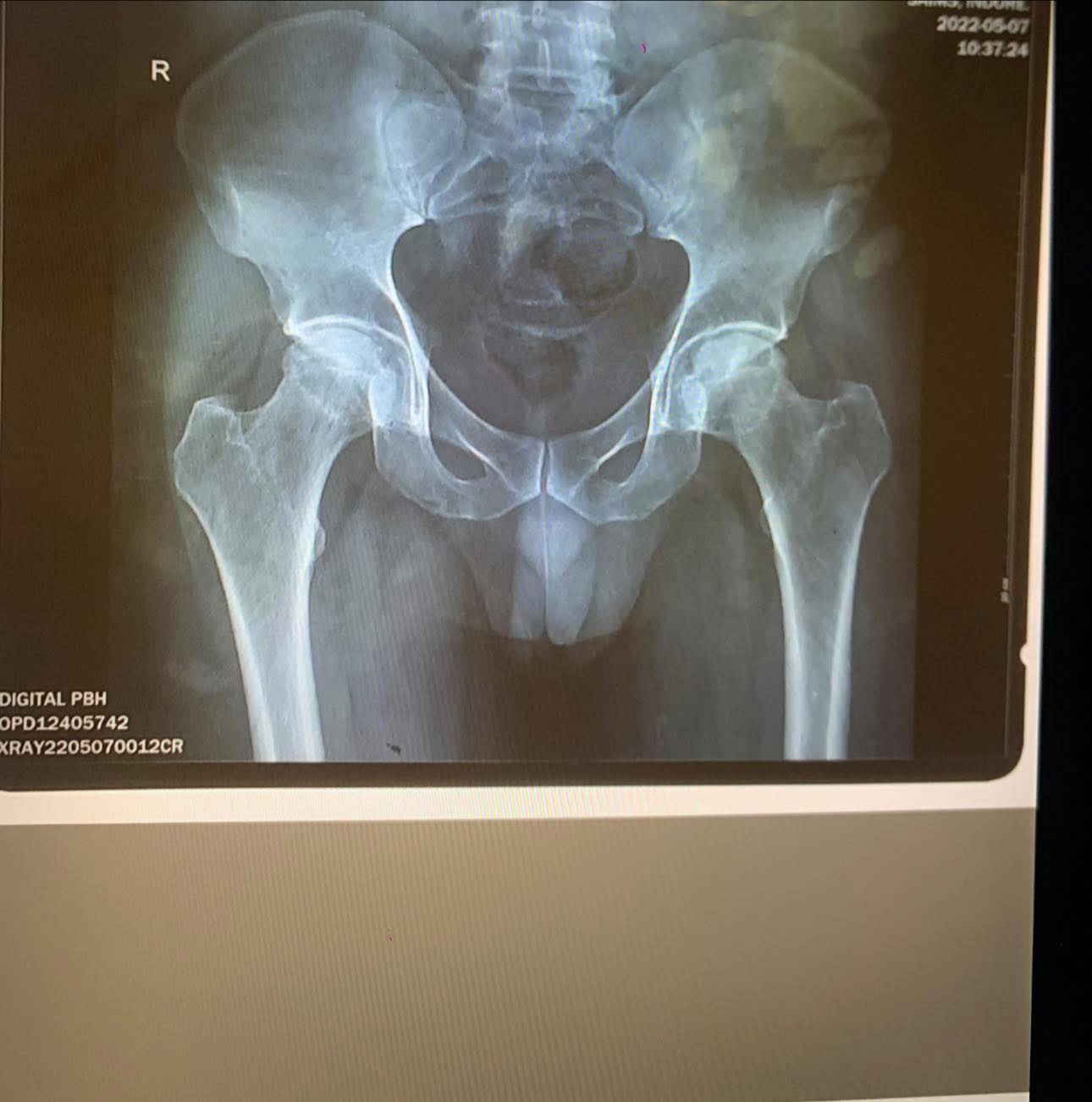 Ever - 57 year old male patient with Hip pain for 6 months. What’s the ...