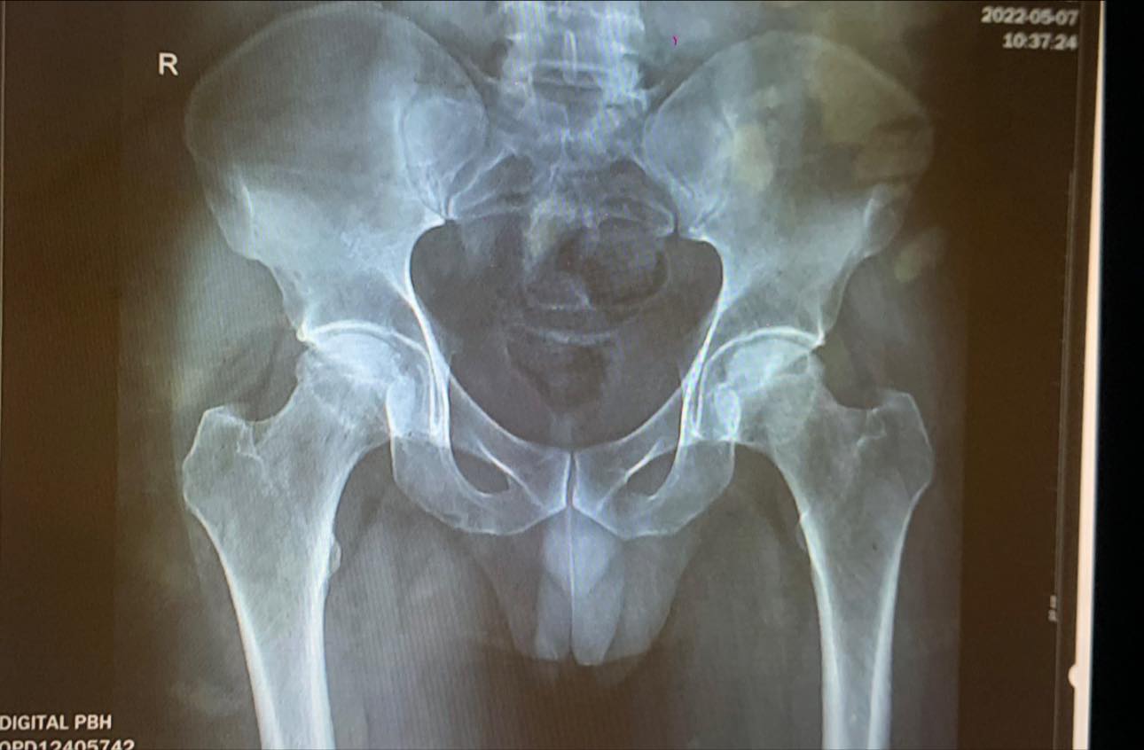 Ever - 58 year old male patient with hip pain for 6 months. What’s the ...