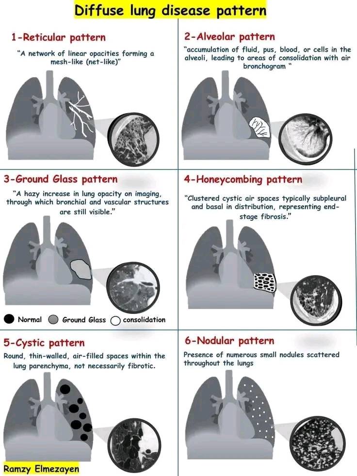 Tabular Summary of Common CT Signs on Pulmonary Imaging ⬇️