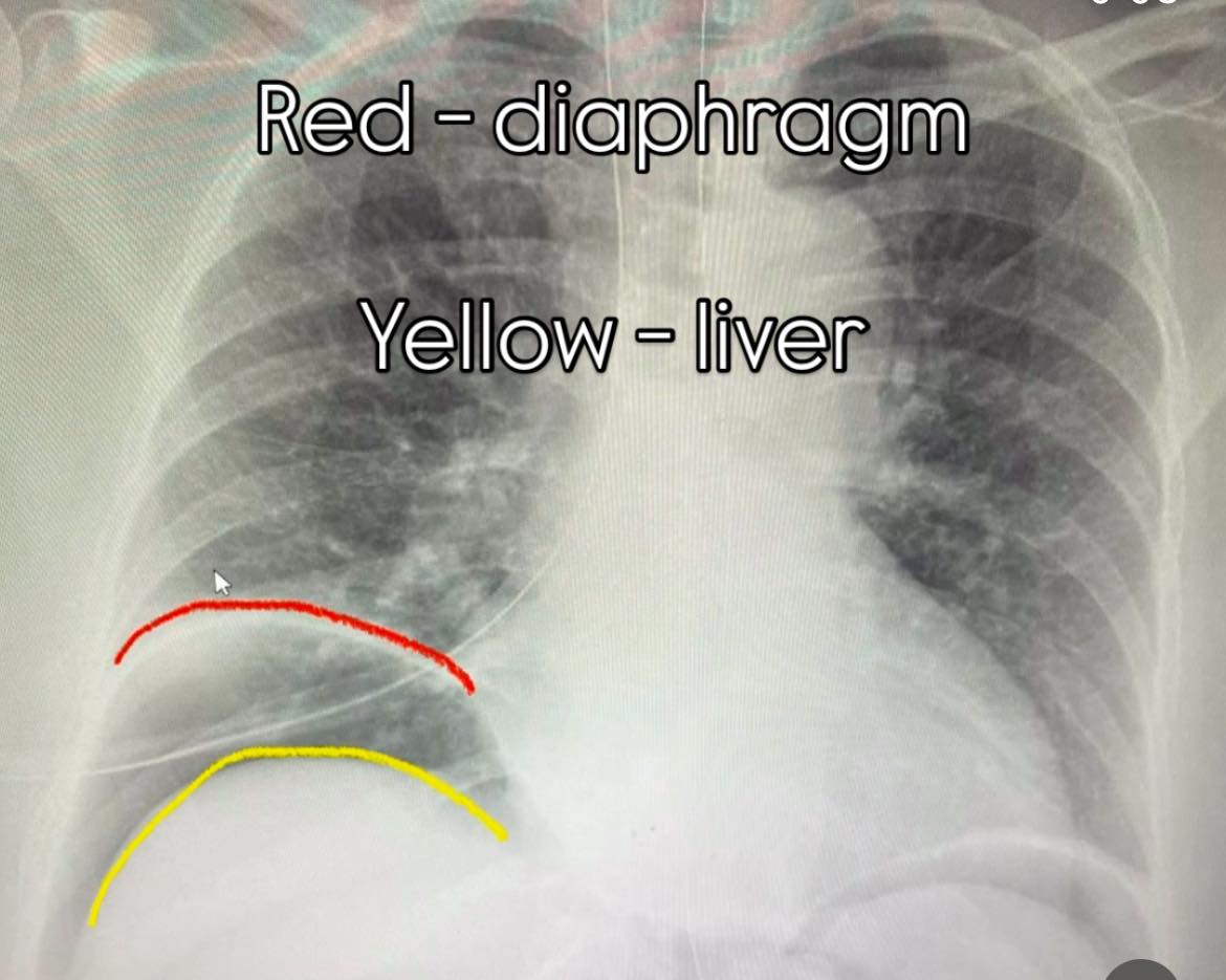 Farshad - 🫁 What Does Pneumoperitoneum Look Like on X-ray ...