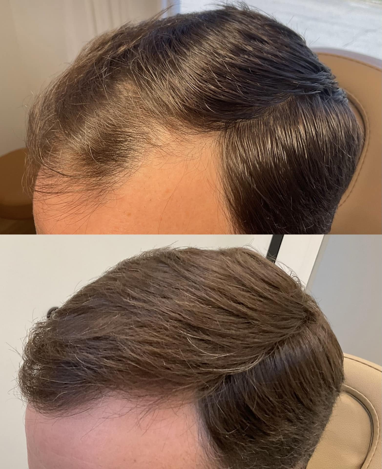 ghk-cu copper peptide hair loss treatment evidence ✨ REAL RESULTS. REAL GROWTH. ✨ injectables + shampoo doing what they do best 💁🏼‍♀️💉🧴 📸 Left → Right • October 8 • November 2 • December 29 This safe
