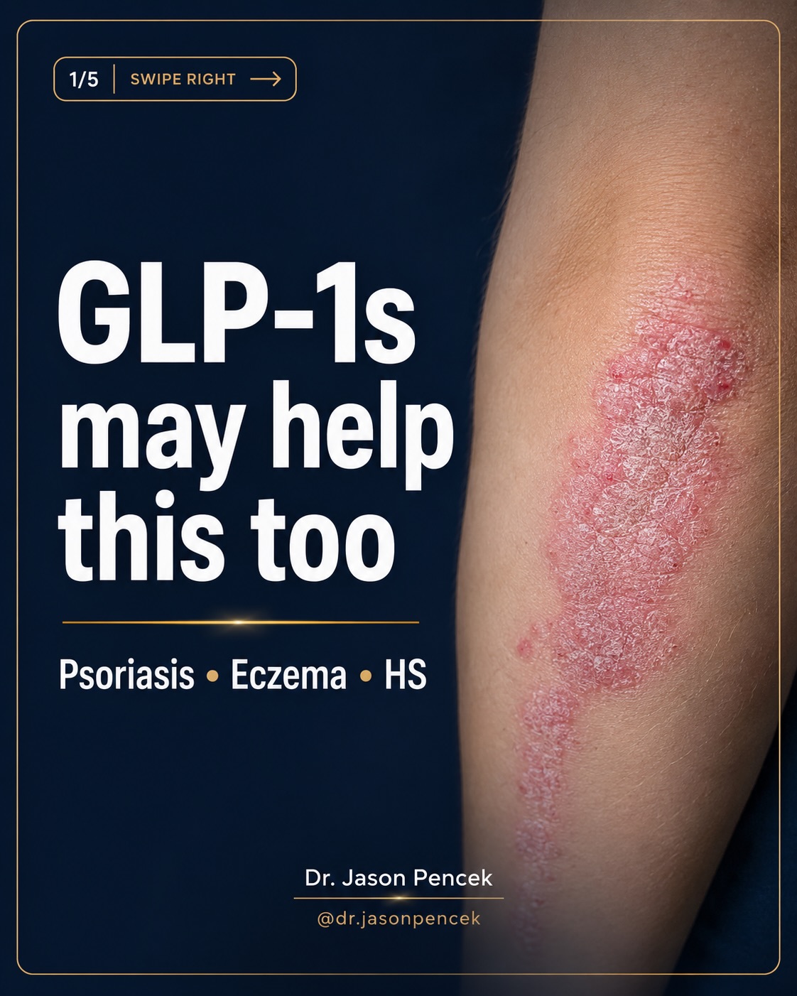 Has glp-1 helped with psoriasis and psoriatic arthritis?