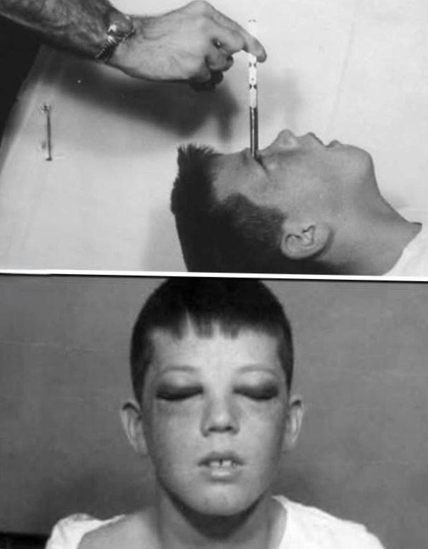 Jaycoroper - In December 1960, twelve-year-old Howard Dully underwent ...