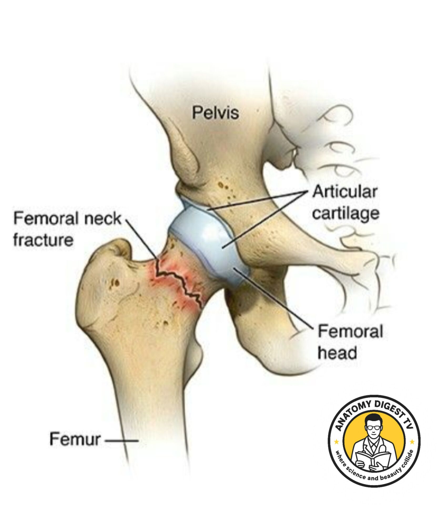 anatomy-the-femoral-neck-fracture-a-femoral-neck-fracture-is-a