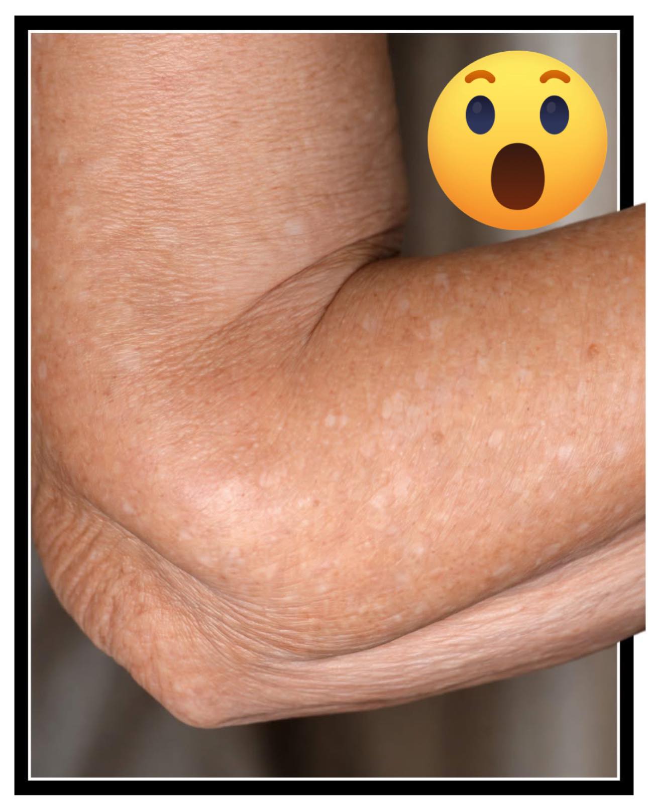 does glutathione cause white spots on skin What is idiopathic guttate hypomelanosis (and should you be concerned)? OxiP®