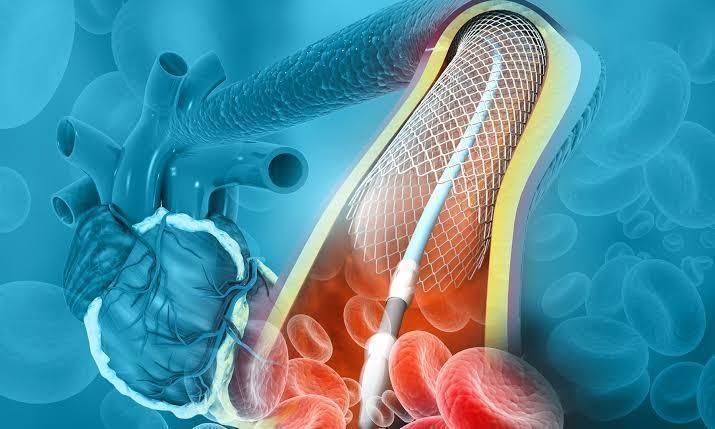 Biology | Mastering Stents A Comprehensive Guide to Types, Placement ...