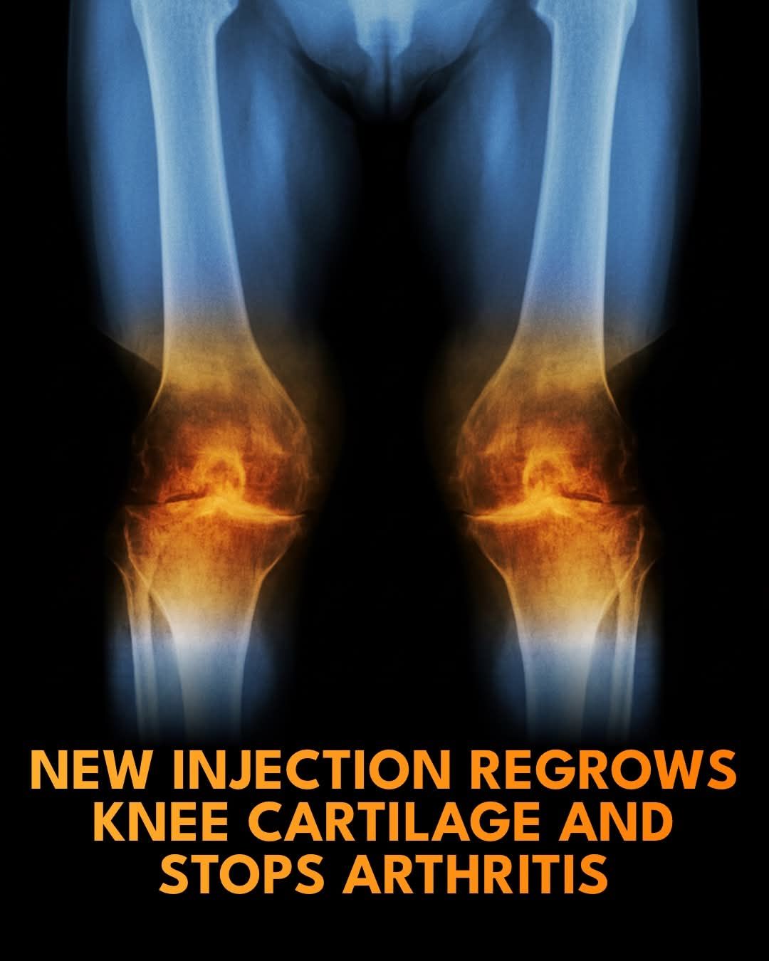 Drug to replenish cartilage in knees?