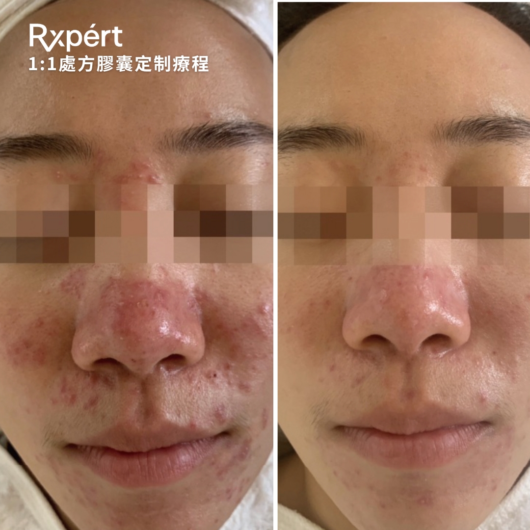 Rxpert.HK - Rxpert的重點特色產品 ⚗️濃縮精華液：代表1:1客製化管理 9種膠囊，提供59049種配方選擇，專為問題性肌膚 ...