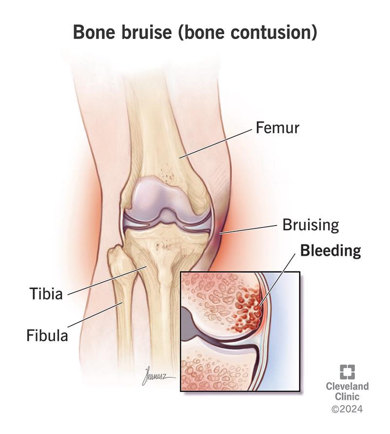 Remuscle - วันนี้มารู้จักคำว่า “Bone Bruise หรือ... | Facebook
