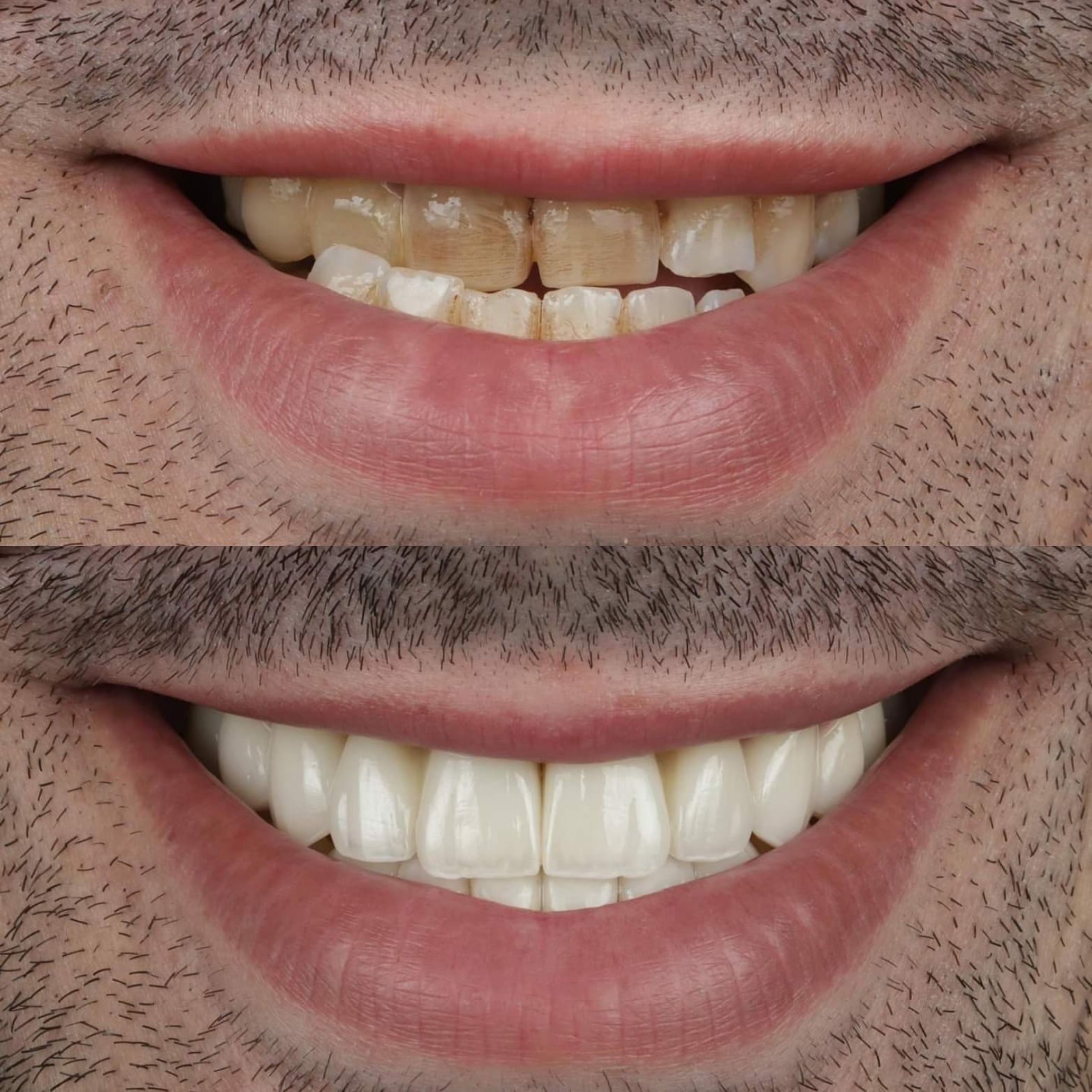 Mamelons - More than wonderful transformation 🤩🤩 | Facebook