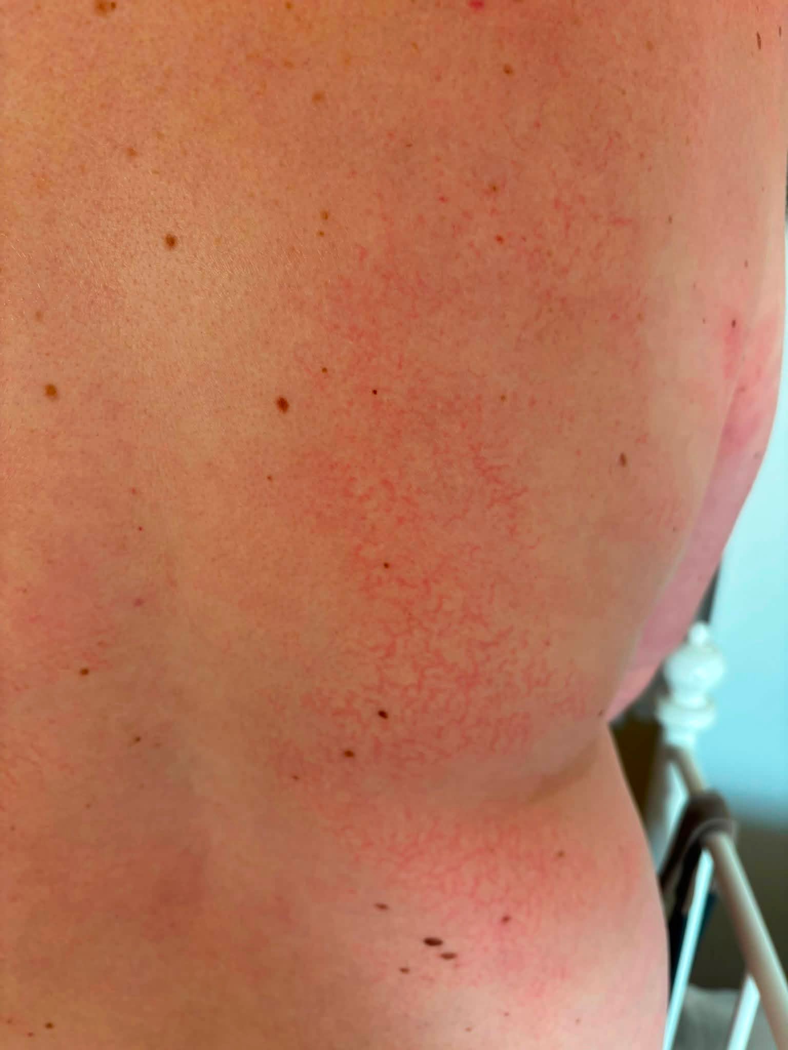 allergic reaction to cjc ipamorelin reactions CJC/Ipamorelin after months of use? injectableb12 Bundle type::NAC + NMN +  Resveratrol cagrilintide