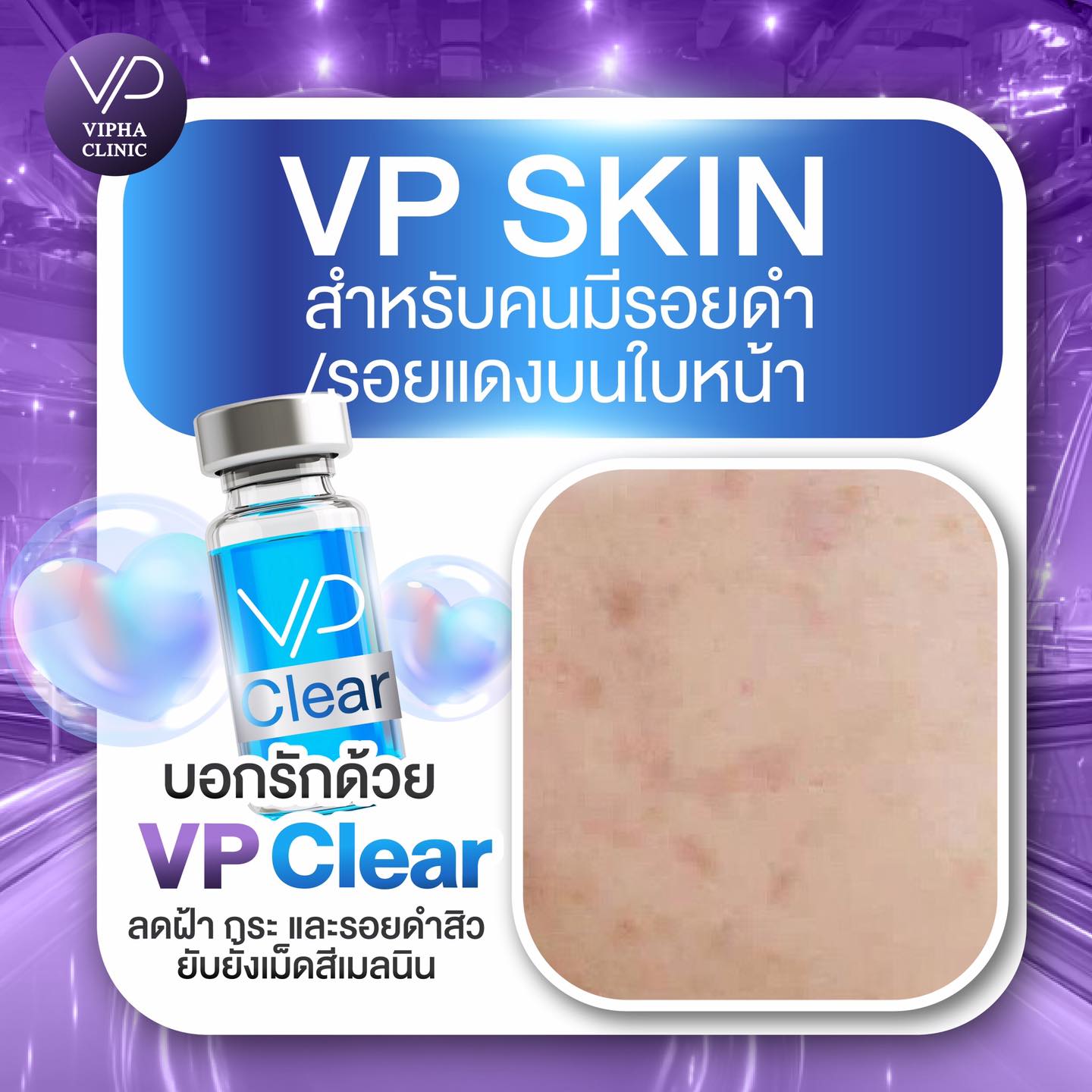 เปรียบเทียบโปรแกรม Filler 🇰🇷... - Vipha Clinic ติวานนท์ | Facebook