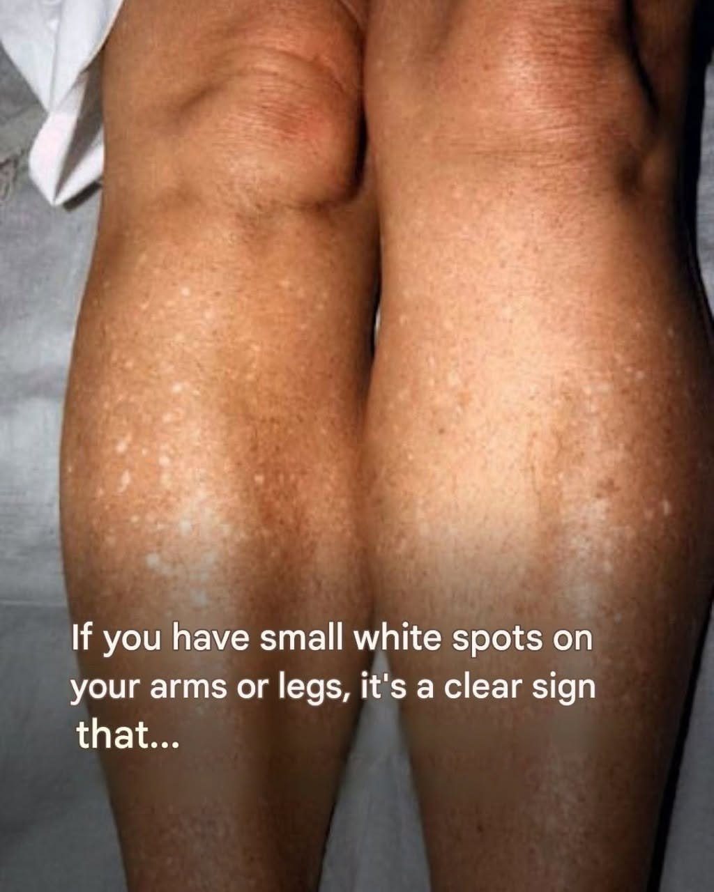 does glutathione cause white spots on skin spots, white patches or discoloration your can happen for a variety of reasons — but are they ever a for concern? 17970 Type:Praline (13 assorted pralines selection) 💉 What are vitamin