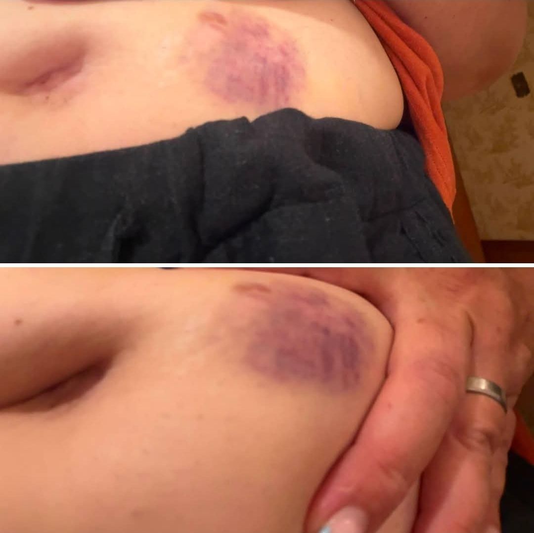 Should I be concerned about bruises after 4 month shots?