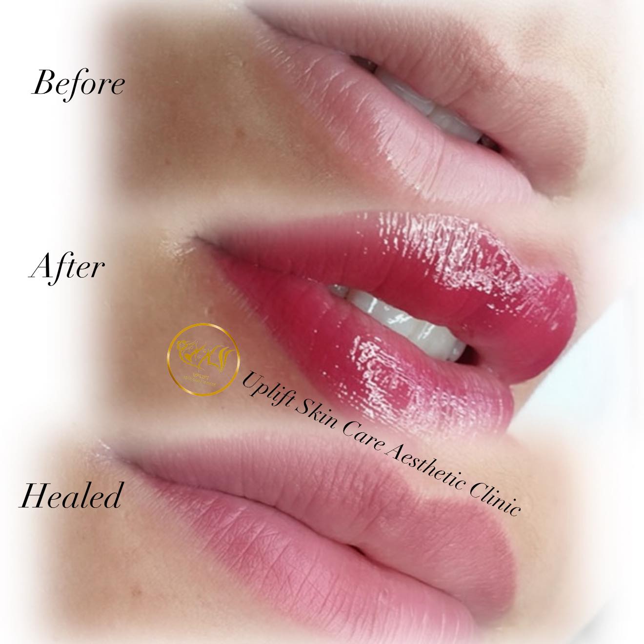 Roma Pink Lips This treatment does not require needles and