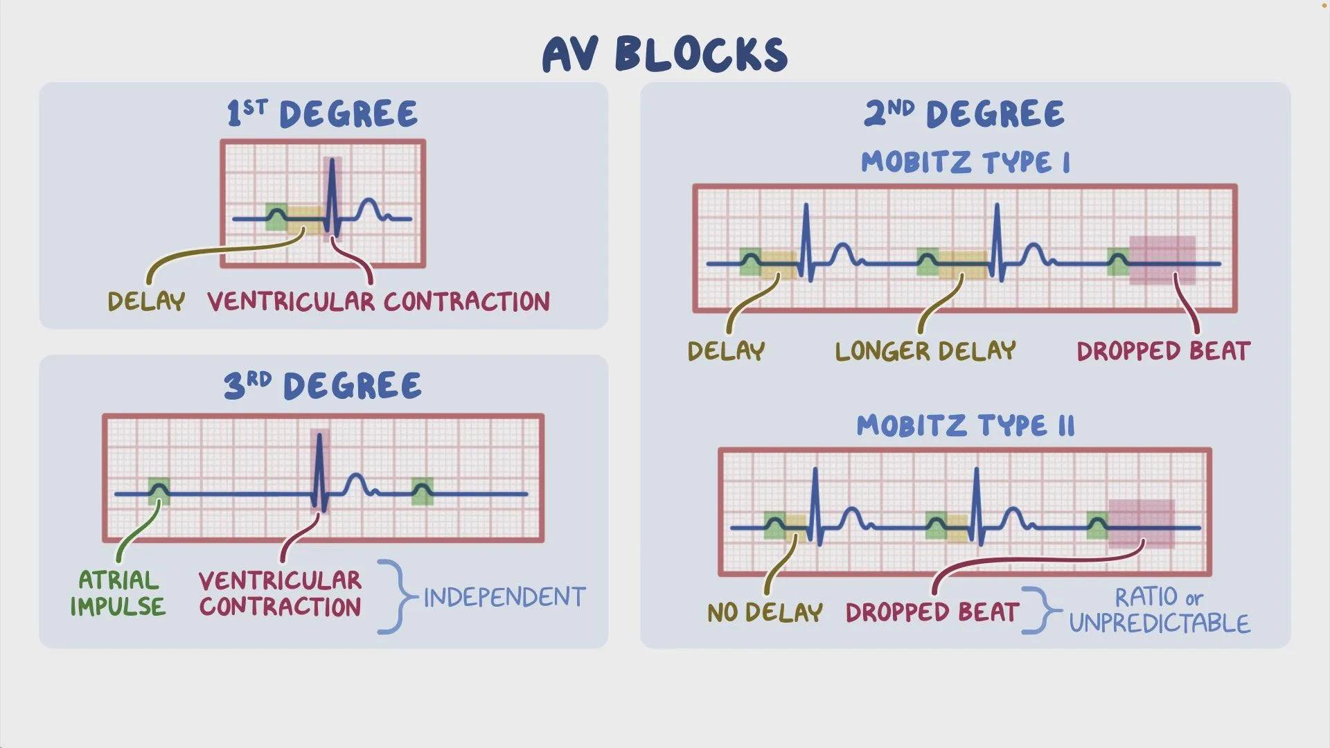 🩺 1. First-Degree AV Block • Usually... - Vet Med Explained | Facebook