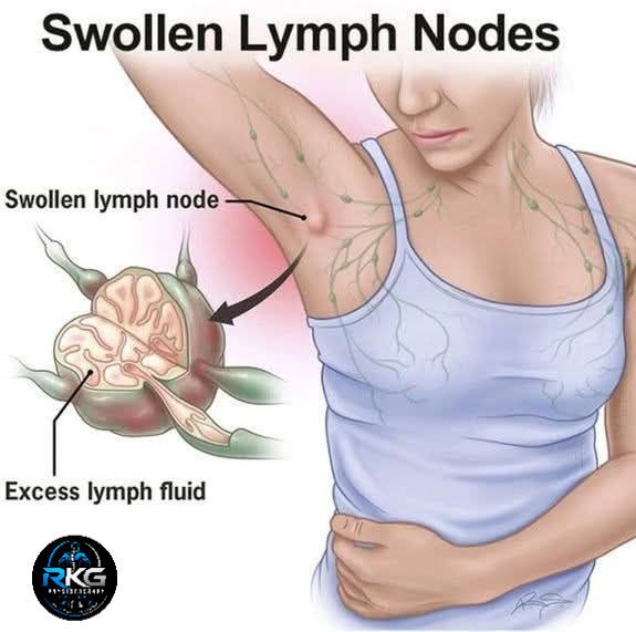 semaglutide swollen lymph nodes and The conversation around GLP-1s is getting louder, but not everything GLP-1 for Lymphedema: Can It