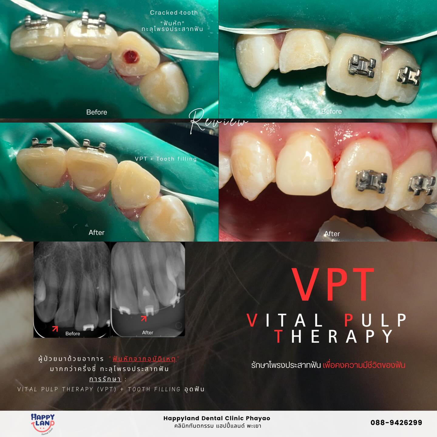 🦷 ฟันหัก/ฟันแตกทะลุโพรงประสาทฟัน “จากอุบัติเหตุ“ สามารถรักษาด้วยวิธี ...