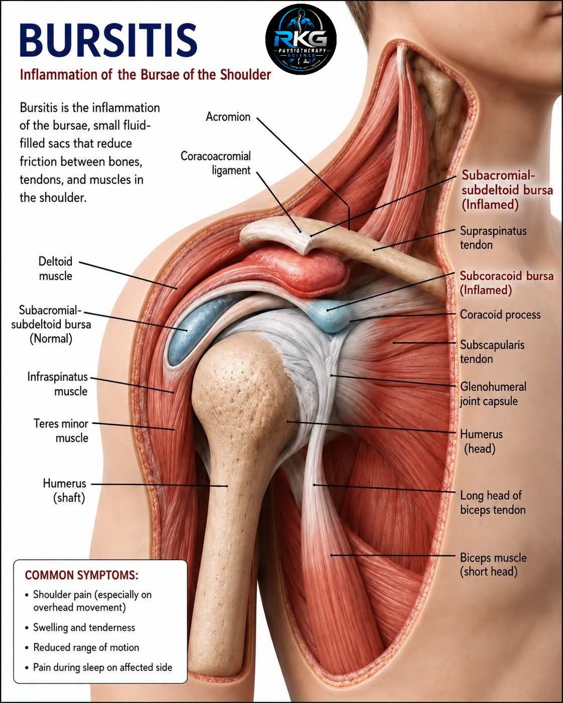 What are regenerative options for shoulder bursitis pain?