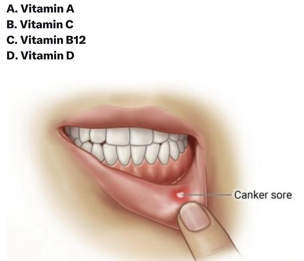 vitamin b12 canker sores dosage injectable What deficiency causes painful mouth ulcers? Synthroid Lipo B12 Injections Benefits, Injection:SubQ
