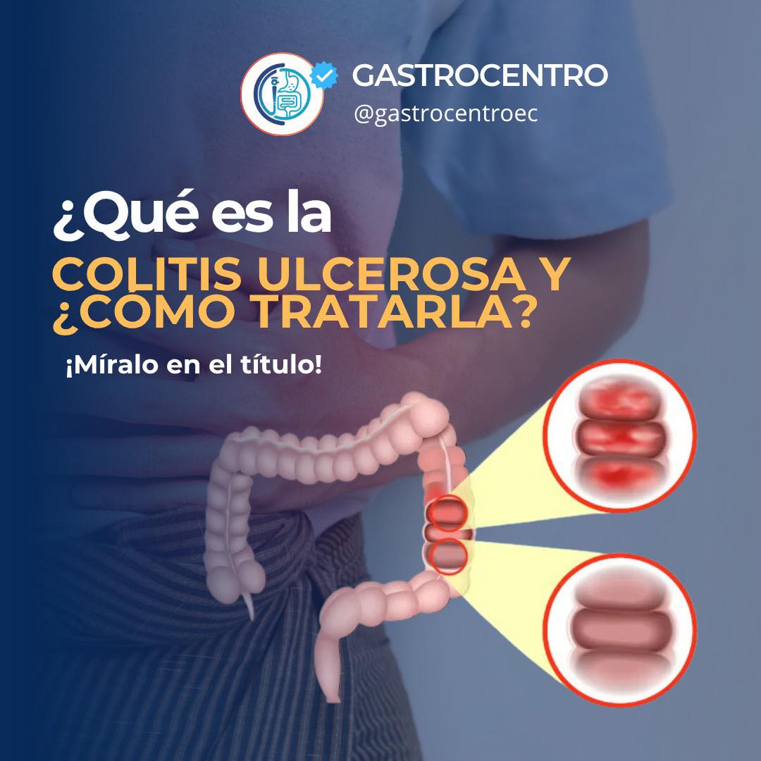 Gastrocentro - ¿Qué es la Colitis Ulcerosa y cómo tratarla? 🌟 Qué es ...