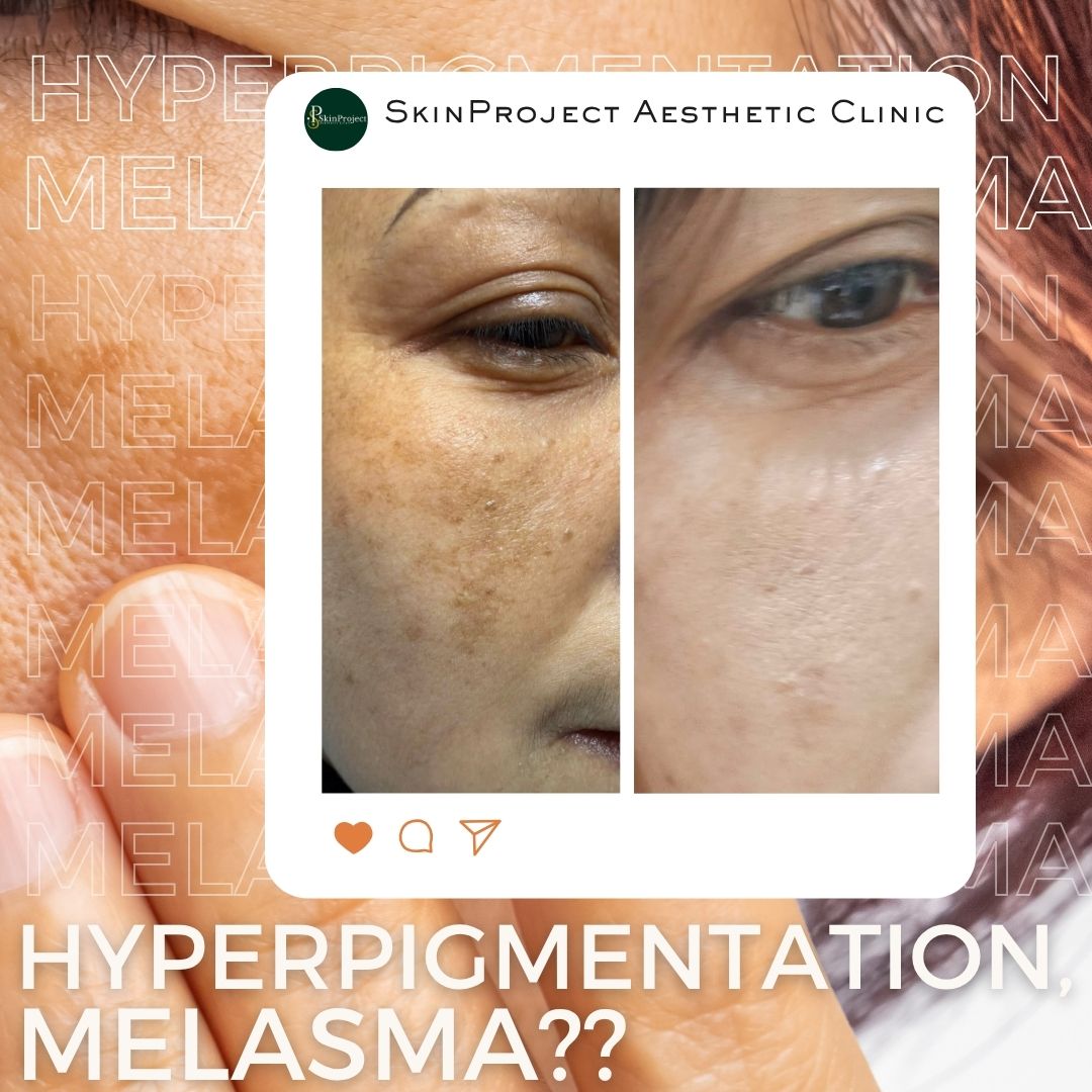 ghk cu melasma ✨ Understanding GHK-Cu for Cellular Wellness For Educational Purposes Only GHK-Cu is a naturally occurring copper peptide complex known for its role in supporting skin and hair vitality. Learn about the potential Are Copper Uglies Real?