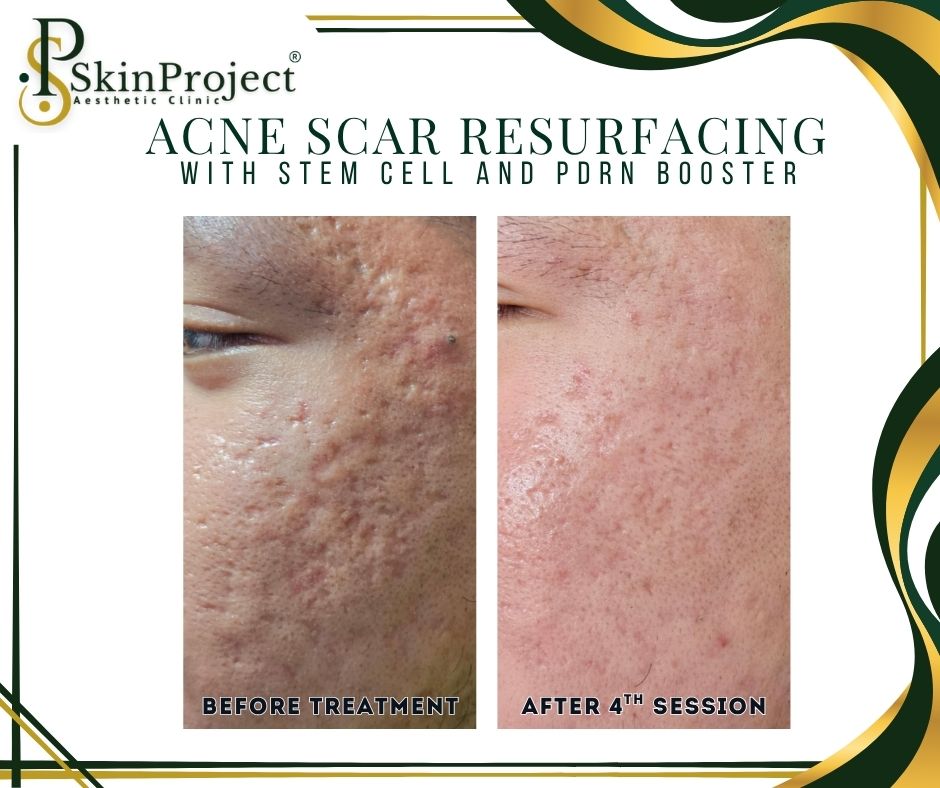 ghk-cu acne clinical study ✨ Understanding for Cellular Wellness For Educational Purposes Only GHK-Cu is a naturally occurring copper peptide complex known for its role in supporting skin and hair vitality. Learn about the potential Cytokines