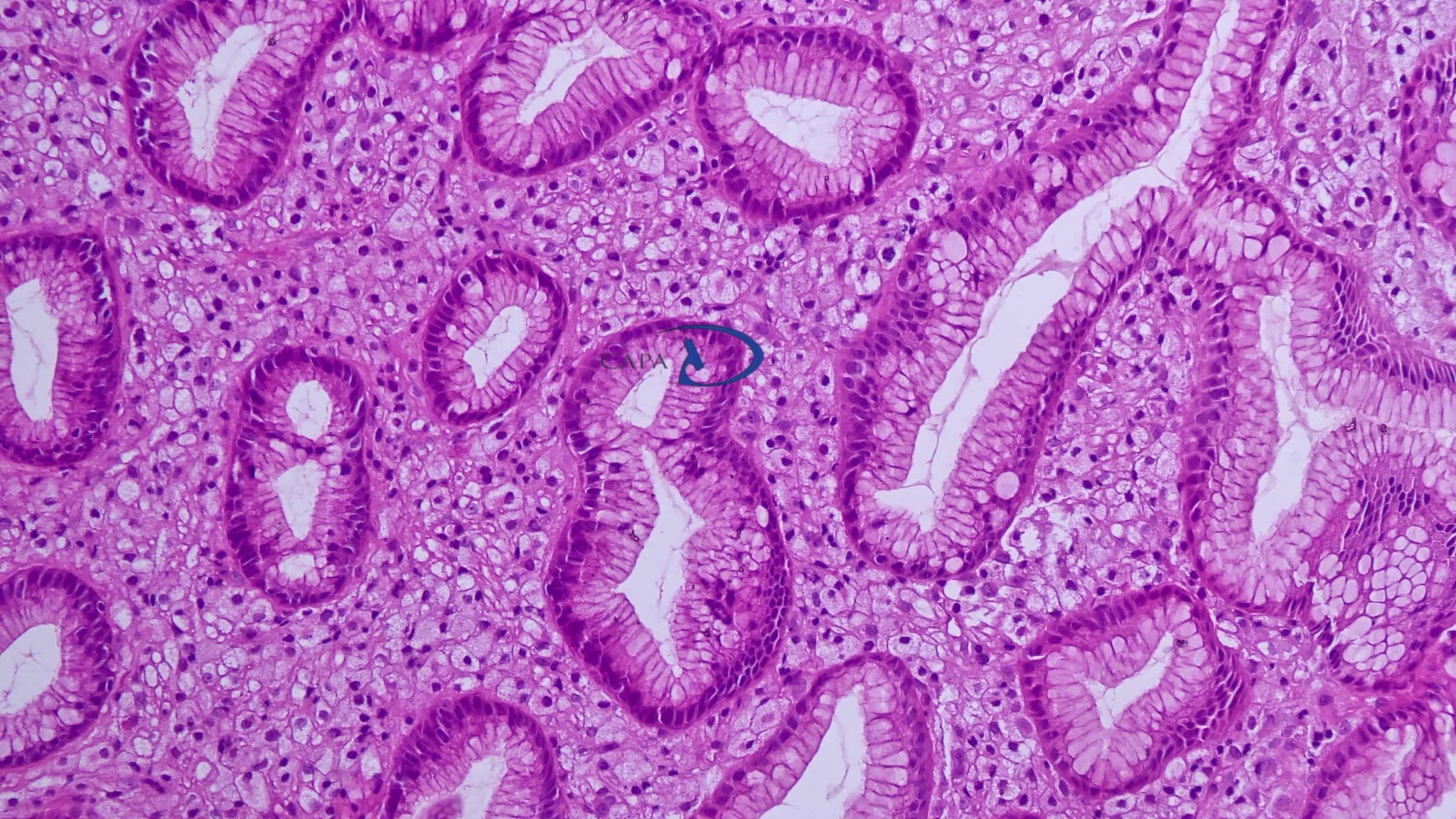 Gastric xanthoma is a benign, non-neoplastic lesion, most often ...