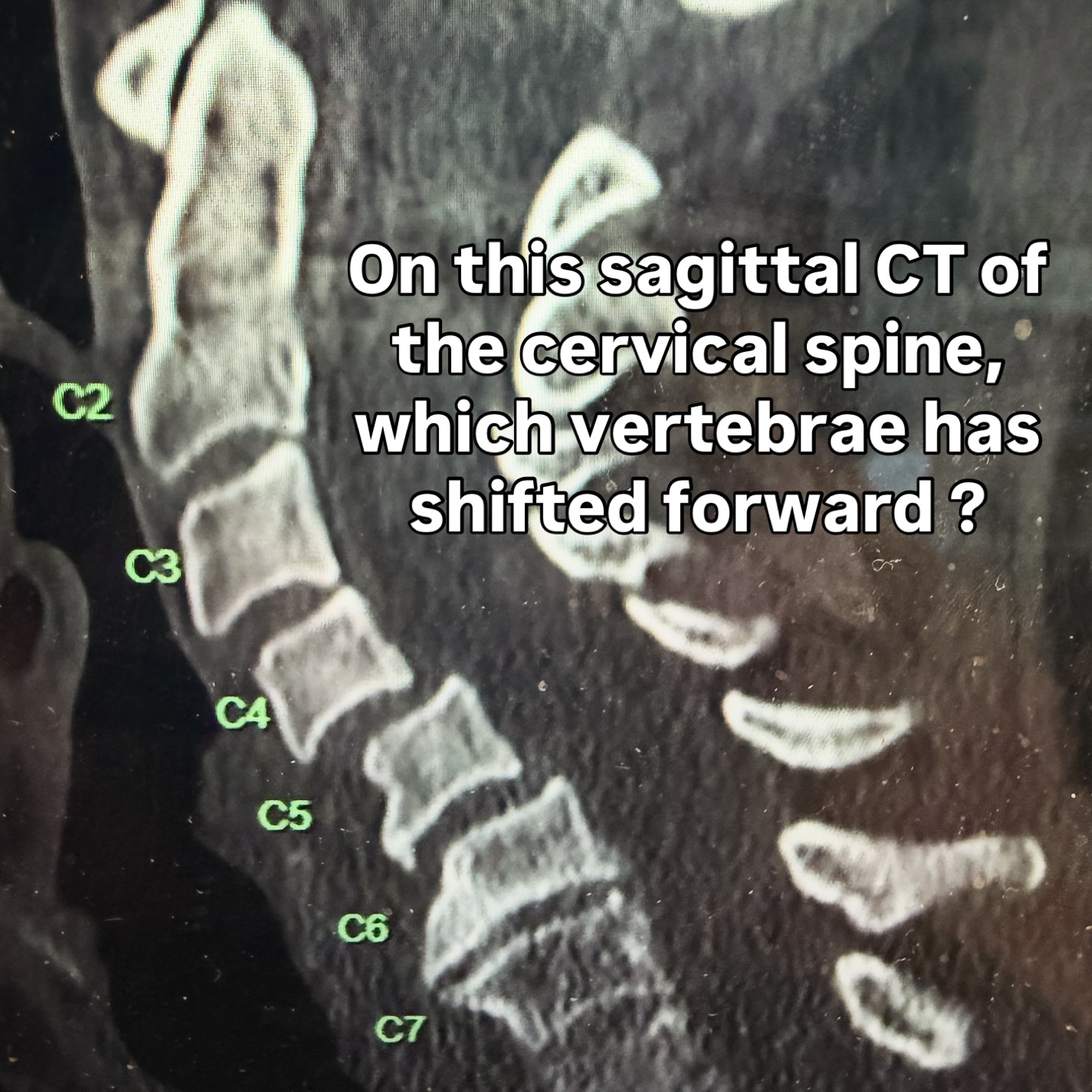 𝗗𝗿. - 🔻FAST CASE CT Mnemonic – 🔻👇🏻 F – Facets → alignment, subluxation ...