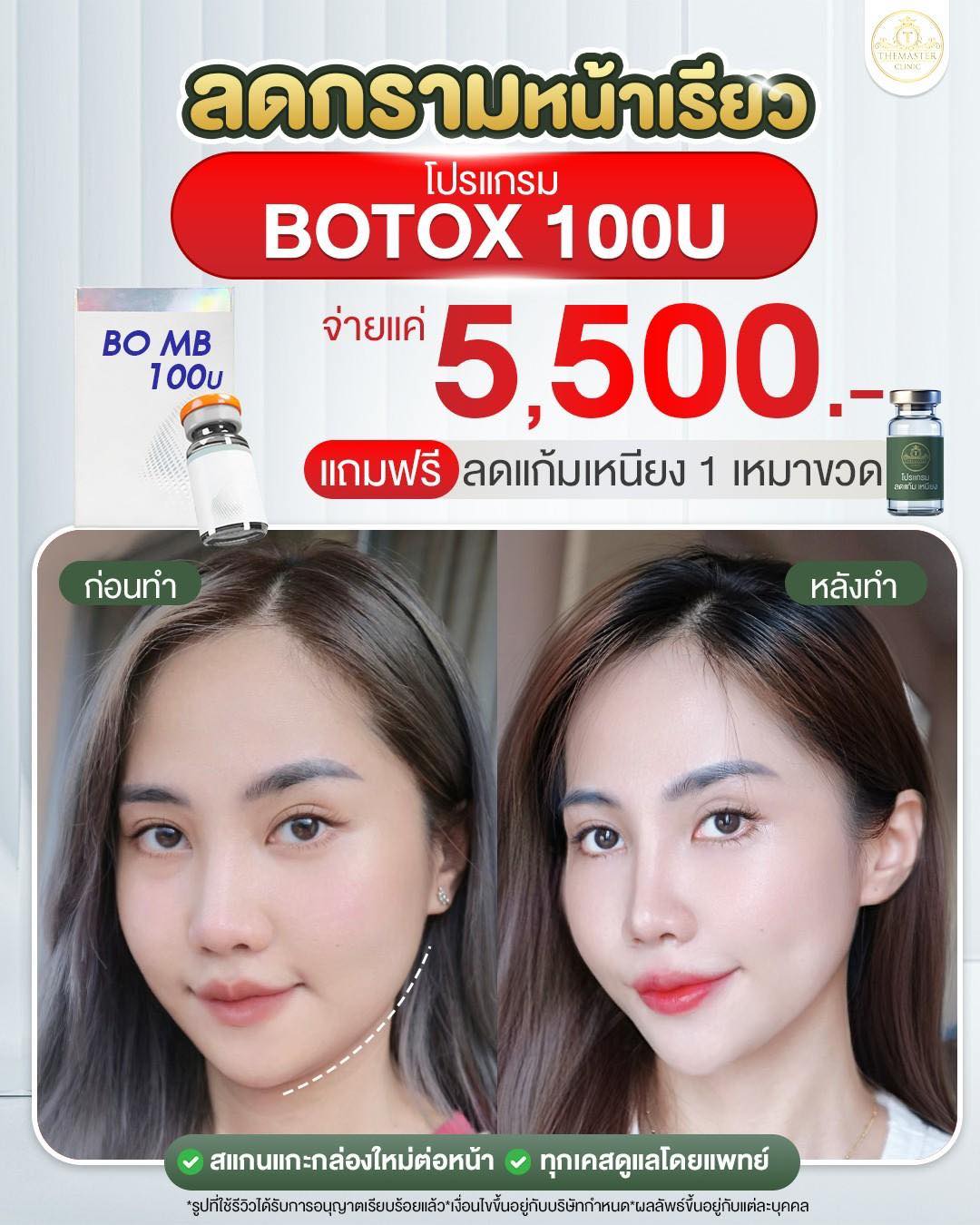 Themaster - จากกรามชัด หน้าเรียวละมุน 💕 ผลลัพธ์จริง หลังทำ Botox 100U ...