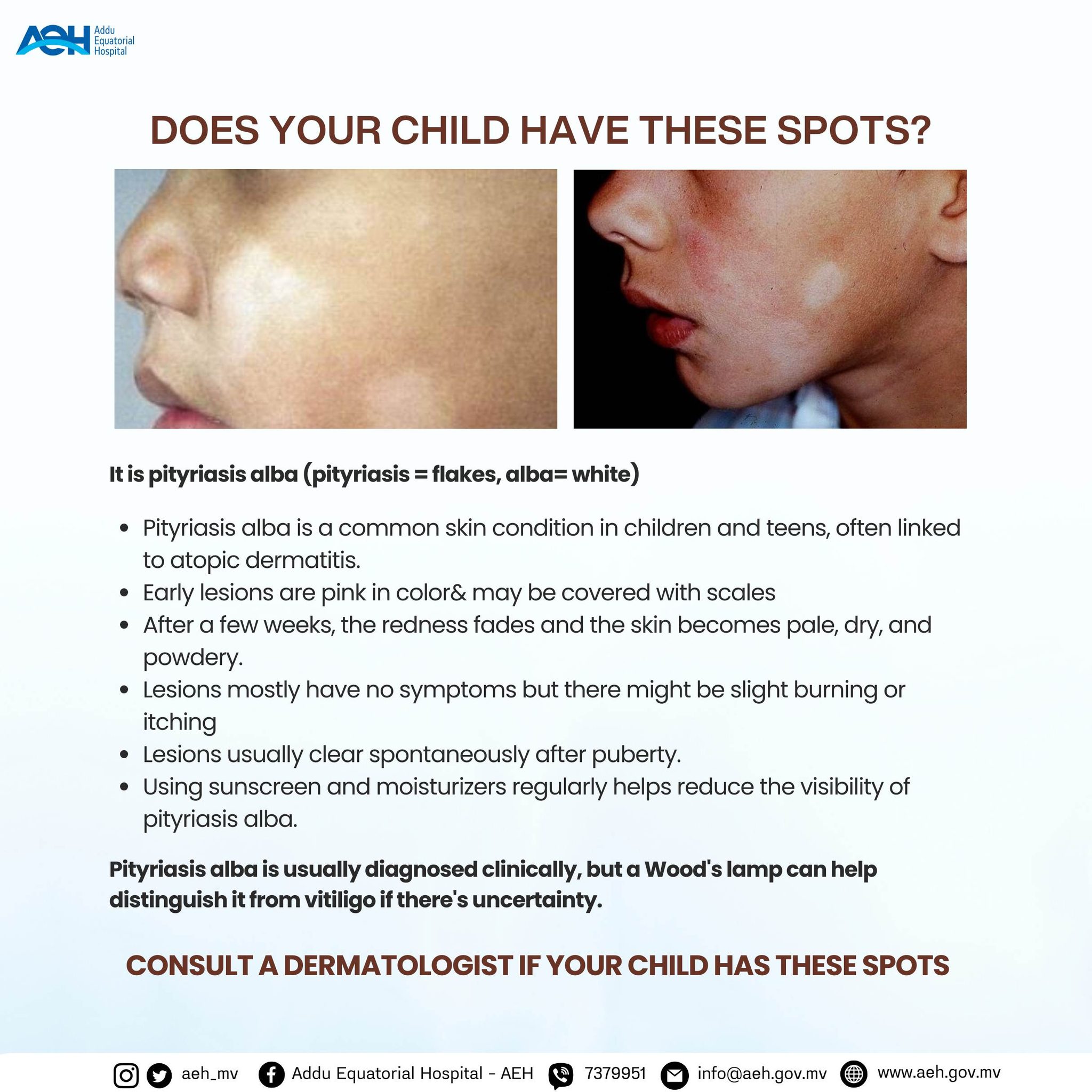 addu-noticed-pale-dry-patches-on-your-child-s-face-it-could-be