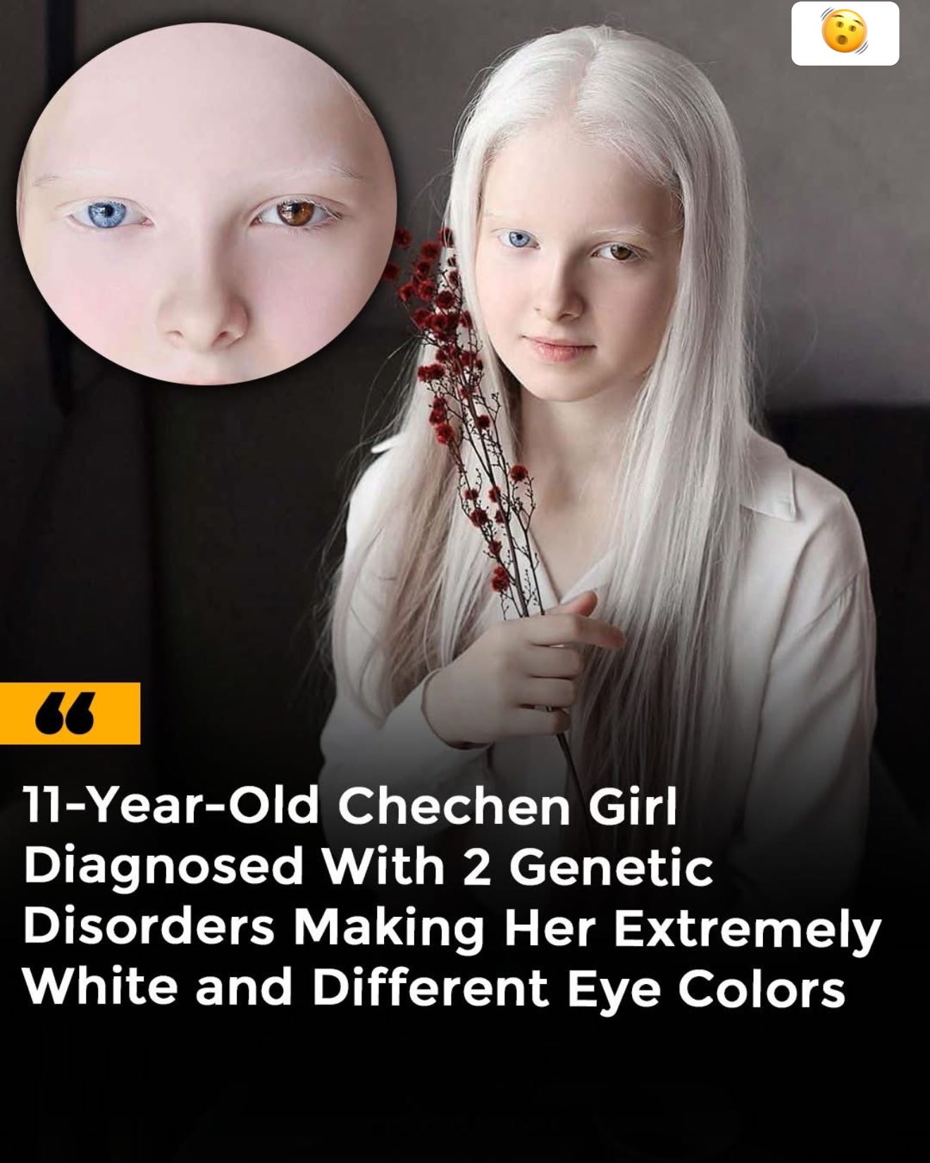 Medical - Amina Ependieva, an 11-year-old from Chechnya, was born with ...