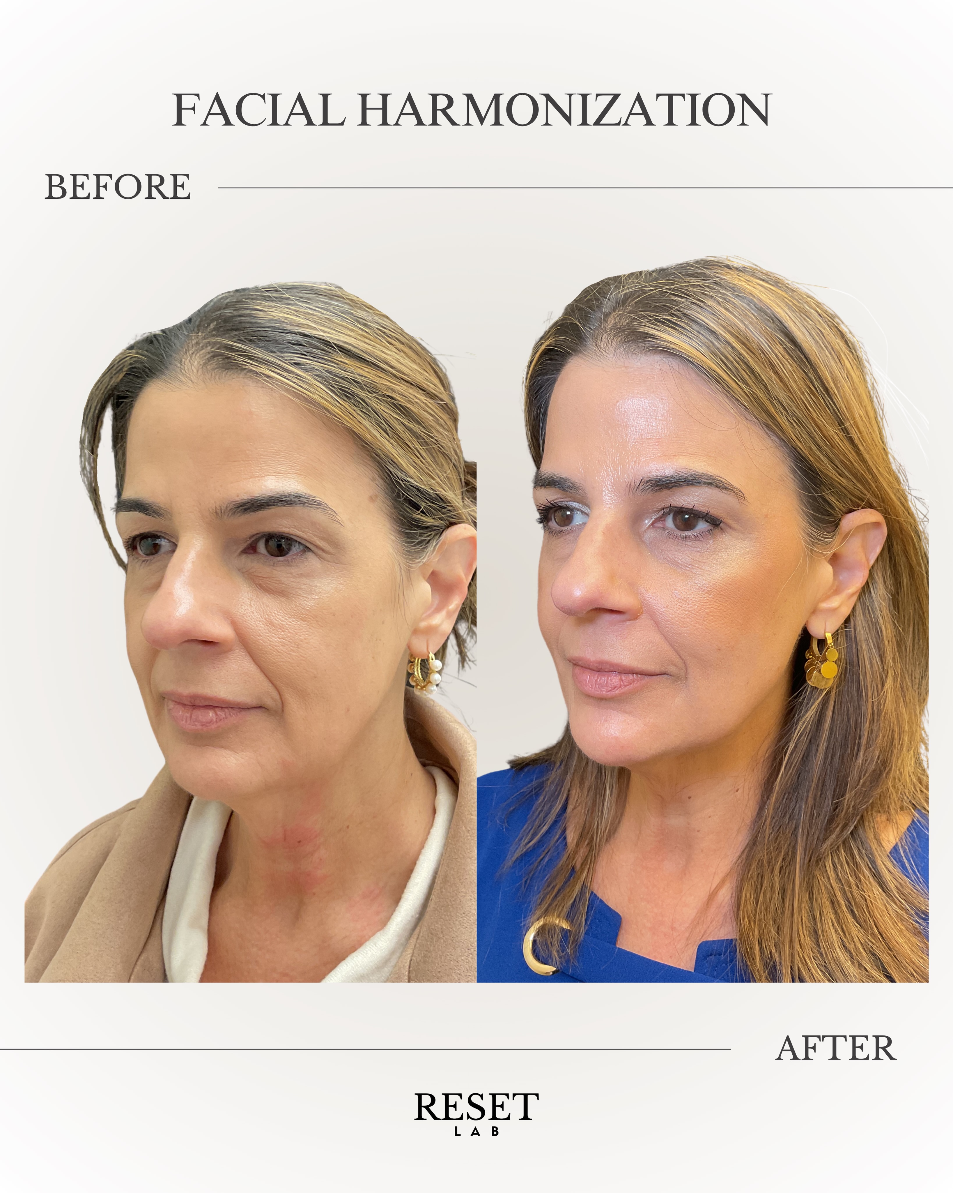 do i need to take vitamin c with glutathione Tablets For Skin Whitening: How Use, Benefits & Side Effects creams glutathione oral shots benefits Quantity:25 kg