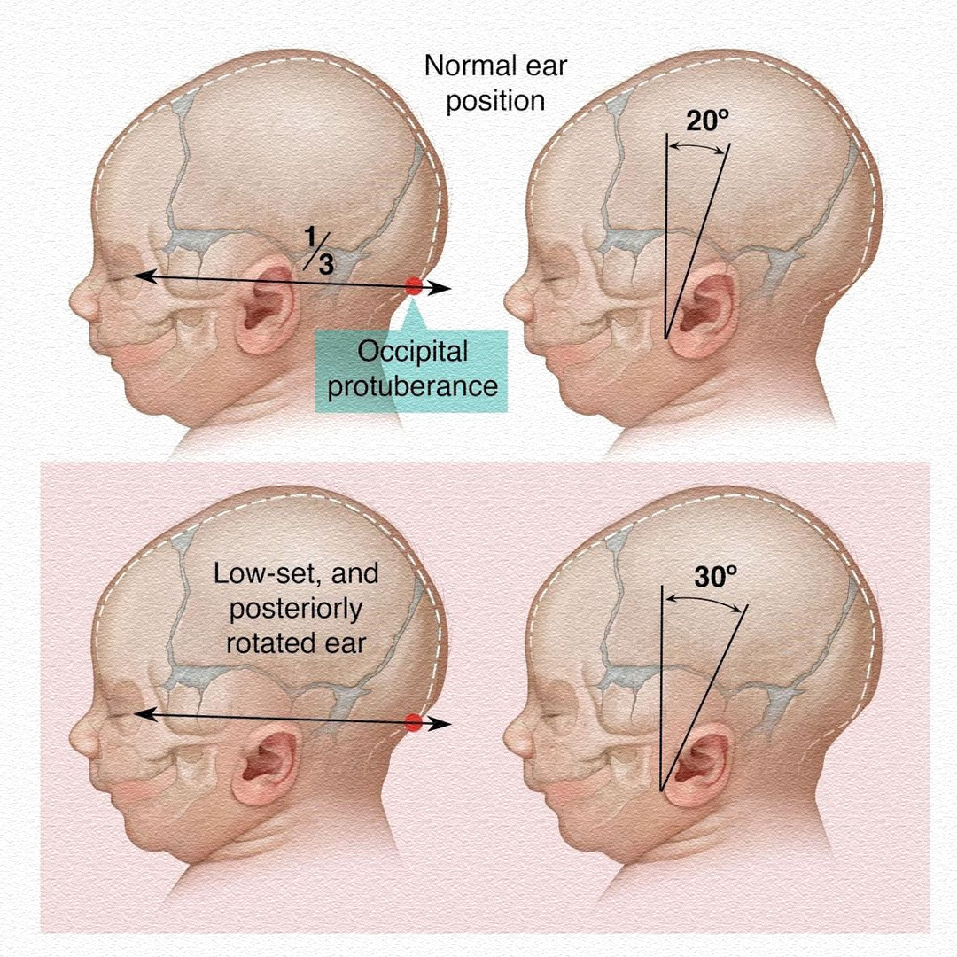 NORMAL EAR POSITION OF BABY 🔹... - Pregnancy & Parenting | Facebook