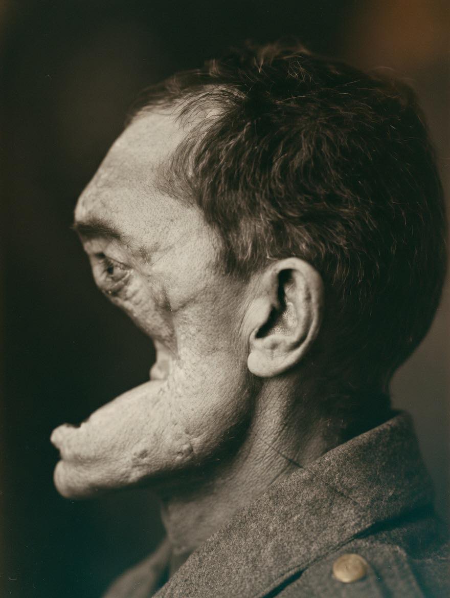 World War I and the birth of plastic surgery